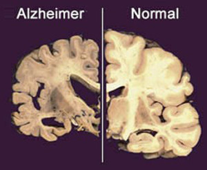 17.Alzheimer cervello